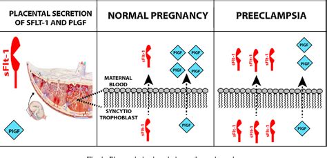 sflt 1|sflt 1 preeclampsia.